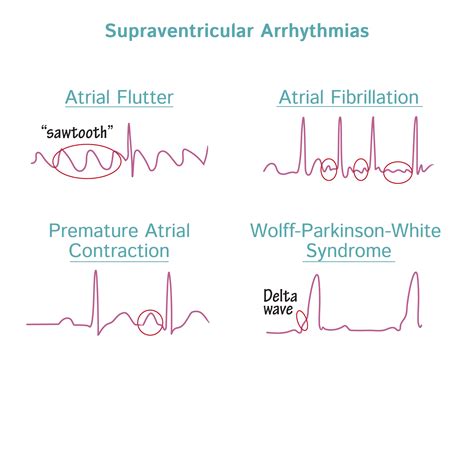what are supraventricular arrhythmias